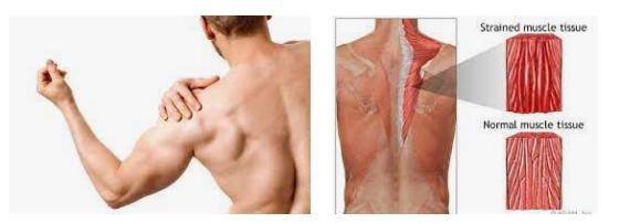 威而鋼引起肌肉酸痛